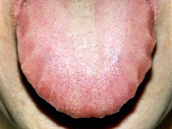 舌 診 写真